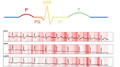 Importance of different ECG segments calculated using vanilla gradients for prediction of indexed left atrial maximum volume (A), indexed left atrial minimum volume (B), left atrial ejection fraction (C) and left atrial to ventricular volume ratio (D) evaluated on 1’077 5 second non-AF ECG samples from 653 patients from the USZ stroke cohort over all 12 leads. Importance was calculated by averaging absolute saliency values over all 12 leads per segment and then dividing by average salience of the entire 5 second ECG sample. (E) Schematic representaion of the ECG segments evaluated in (A)-(D). (F) Example saliency map for leads I-III. Darker red indicates high absolute saliency. LA max: indexed left atrial maximum volume, LA min: indexed left atrial minimum volume, LAEF: left atrial ejection fraction, LALV: left atrial to ventricular volume ratio.